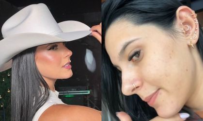 Montagem com fotos da cantora Ana Castela maquiada e mostrando a diminuição de acne na pele