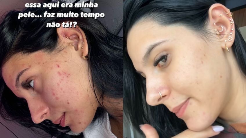 Boiadeira comparou fotos de antes e depois do tratamento contra acne (crédito: reprodução)