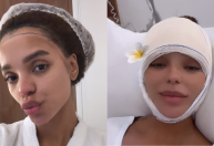 Brunna Gonçalves passa por cirurgia de frontoplastia: 
