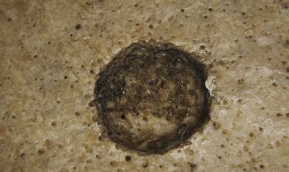 Remoção de tumor em crânio de 4 mil anos revela marco no tratamento de câncer