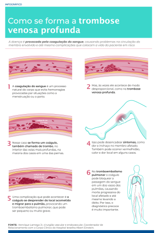 A trombose venosa profunda é provocada pela formação de um coágulo no interior de uma veia, podendo dificultar ou até mesmo obstruir o retorno do sangue ao coração / Agência Einstein/Reprodução