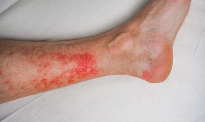 Erisipela