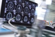 O que é hematoma subdural e como é feito o tratamento