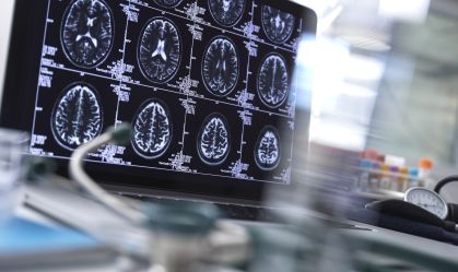 Imagem de destaque do post: O que é hematoma subdural e como é feito o tratamento