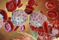 O que é leucemia linfocítica crônica? Conheça sintomas e tratamento