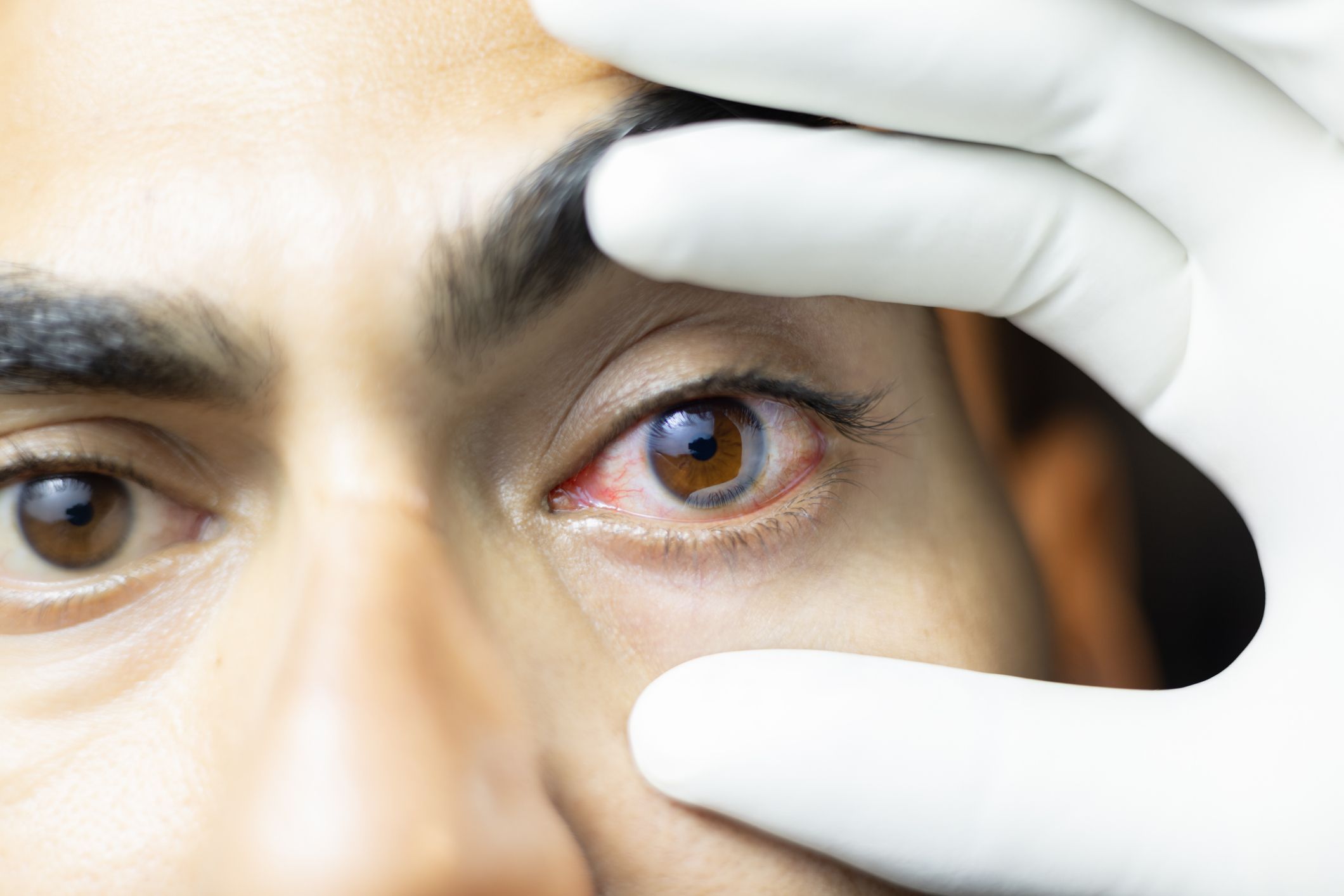 Melanoma ocular