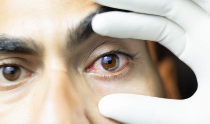 Novo método de terapia fotodinâmica pode erradicar o melanoma ocular, diz estudo