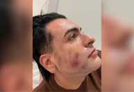 Homem que morreu em clínica de SP pagou R$ 4.500 por ‘peeling de fenol’