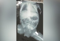 Grávida é baleada no Maranhão e médicos fazem cirurgia em bebê