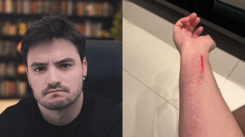 Felipe Neto mostrado machucado após cair em casa
