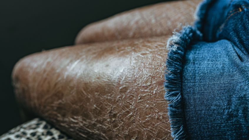 Ictiose vulgar é uma doença hereditária que provoca um forte ressacamento na pele / Igor Alecsander/Getty Image