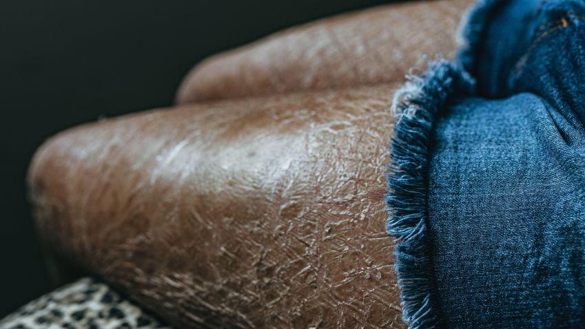 Ictiose vulgar é uma doença hereditária que provoca um forte ressacamento na pele / Igor Alecsander/Getty Image