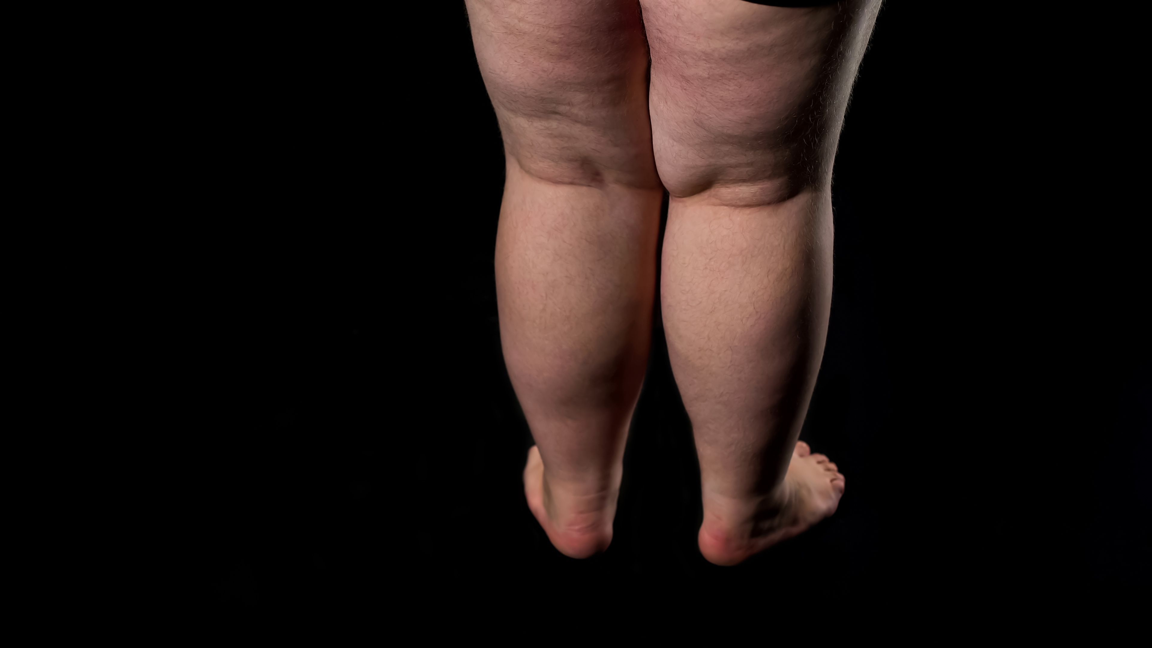 Fat male legs with sagging skin and cellulite, excessive food intake health care