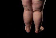 O que causa lipedema? Conheça sintomas e tratamentos para a doença