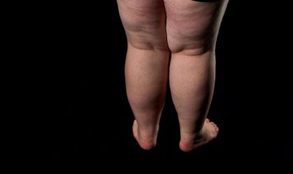 O que causa lipedema? Conheça sintomas e tratamentos para a doença