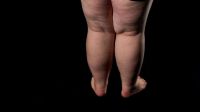 O que causa lipedema? Conheça sintomas e tratamentos para a doença