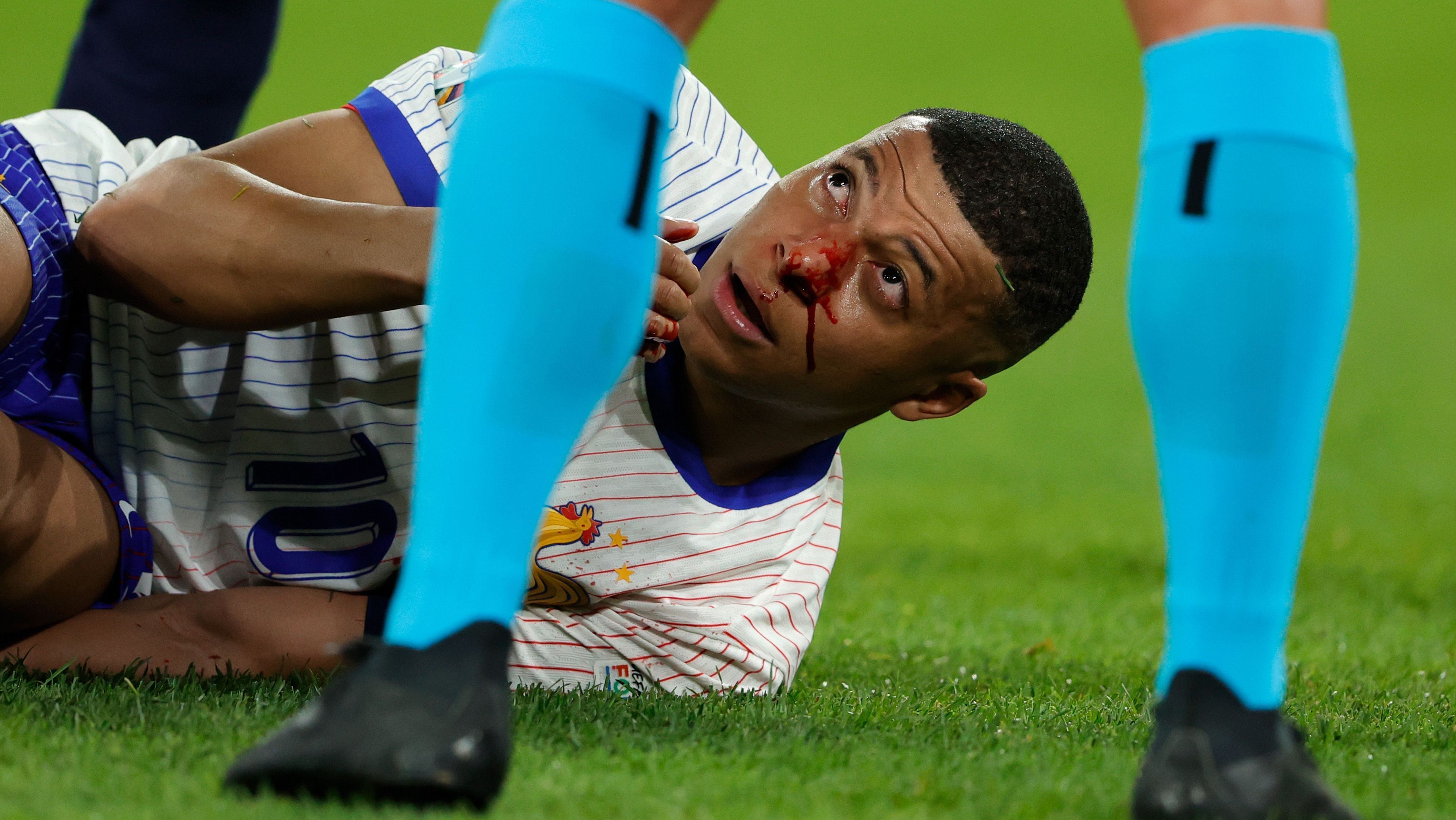Mbappé fraturou o nariz na vitória sobre a Áustria