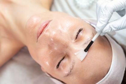Peeling de fenol é um procedimento que utiliza ácido para rejuvenescer a pele