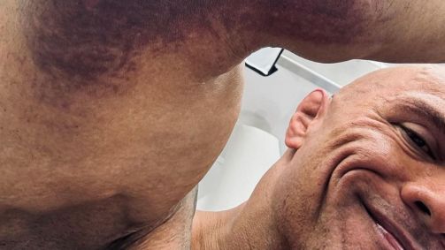 Dwayne Johnson mostra hematomas no cotovelo