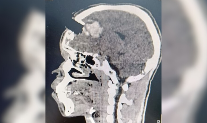 Imagem do crânio de homem que sofreu perfuração de 6 centímetros por uma estaca de madeira