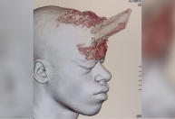 Homem que teve crânio perfurado por madeira está internado em estado grave no RJ