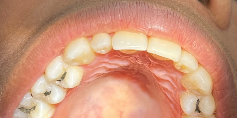 Amálgama de mercúrio usado em dente