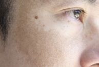 Melasma: conheça os principais sintomas e saiba como prevenir e tratar