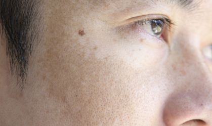 Melasma é mais frequente em pessoas com tons de pele médios e escuros, segundo o American Board of Dermatology