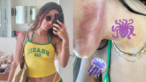 Anitta mostra marca de queimadura de água-viva em Ibiza, na Espanha
