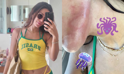 Anitta é queimada por água-viva em Ibiza: "Dor que nunca senti na vida"