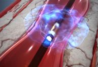 Cirurgia vascular para prevenir AVC é realizada pela primeira vez no Brasil