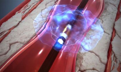 Cirurgia vascular para prevenir AVC é realizada pela primeira vez no Brasil