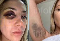 Fotos da ex-primeira-dama da Argentina mostram hematomas após agressões de Alberto Fernández, diz site