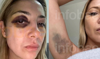 Fotos da ex-primeira-dama da Argentina mostram hematomas após agressões de Alberto Fernández, diz site