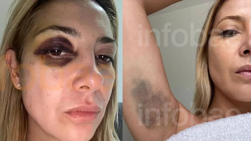 Fabiola Yañez, ex-primeira-dama da Argentina, aparece com hematomas pelo corpo após supostas agressões de Alberto Fernández / Reprodução/Infobae