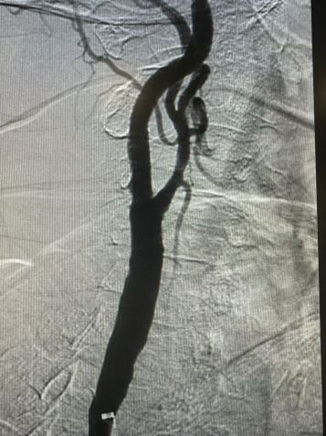 Cirurgia vascular para prevenir AVC é realizada pela primeira vez no Brasil • Divulgação