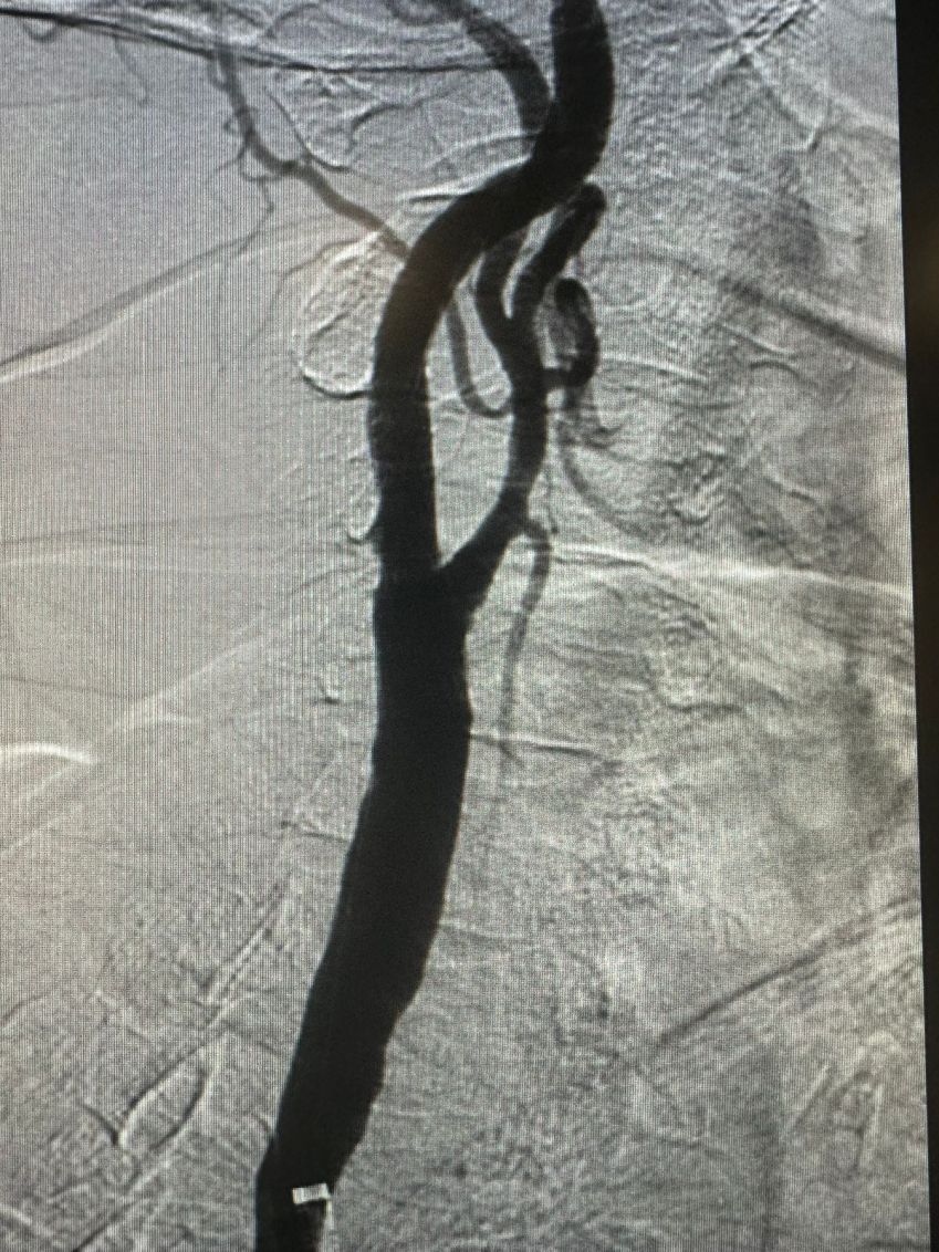 Cirurgia vascular para prevenir AVC é realizada pela primeira vez no Brasil • Divulgação