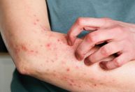 Quais são os primeiros sintomas da mpox no organismo? Infectologista explica