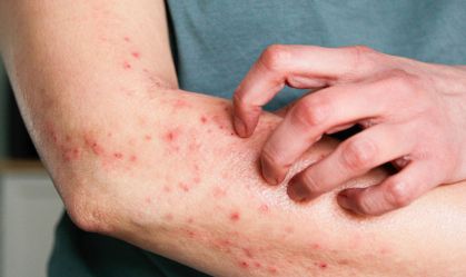 Mpox: OMS aprova primeira vacina para uso emergencial em crianças