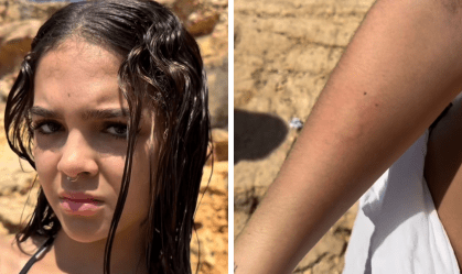 Mel Maia é queimada por água-viva em Ibiza: "Horrível"
