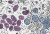 Mpox: especialista explica transmissão, sintomas e medidas de prevenção