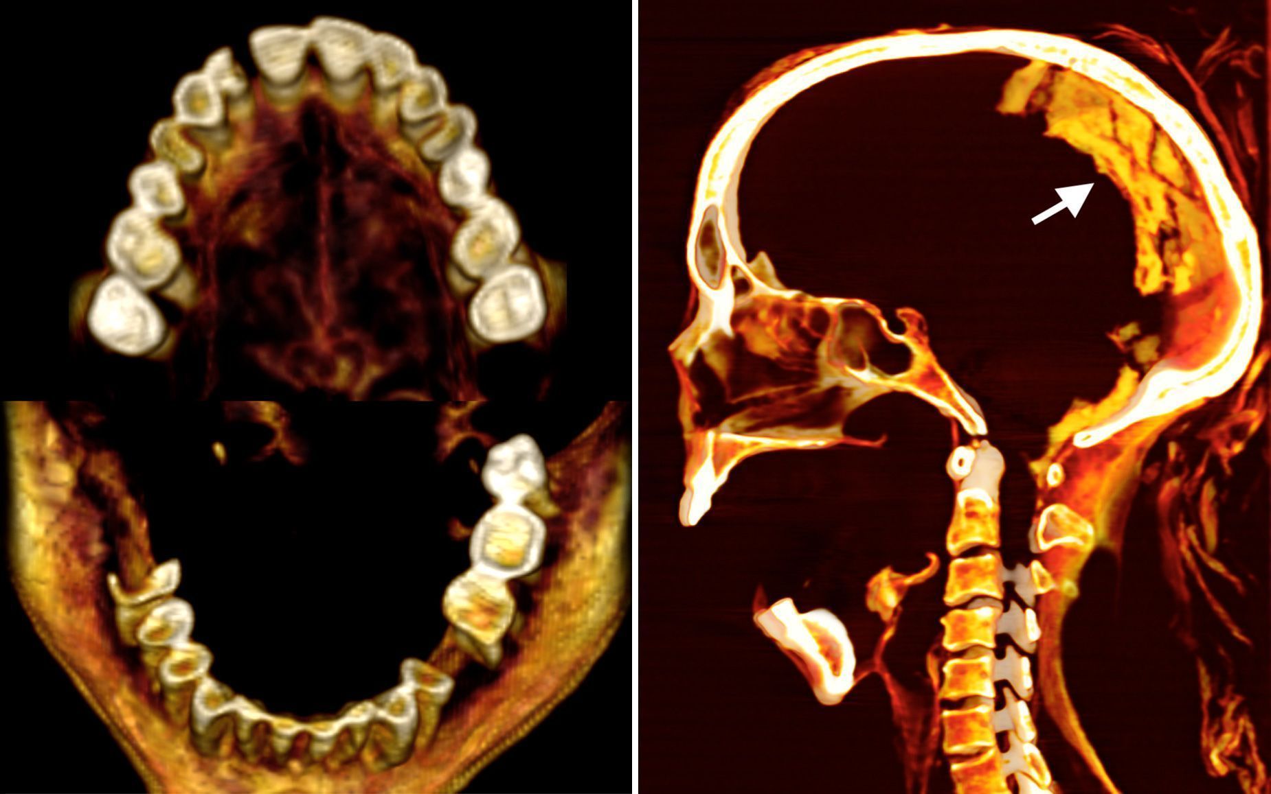 Tomografias, incluindo dos dentes (à esquerda) e do cérebro, revelaram novos detalhes sobre a morfologia, condições de saúde e preservação da múmia / Sahar Saleem via CNN Newsource