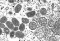 Amazonas registra 33 casos de Mpox em 2025
