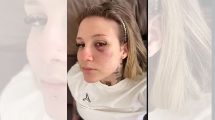 Clara Monteiro publicou fotos nas redes sociais com hematomas no rosto