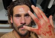 Nicolas Prattes mostra machucado após gravar novela: "Coronhada foi de verdade"