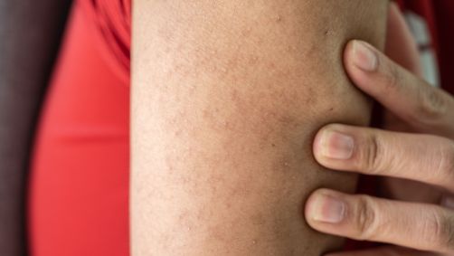 Queratinose pilar é uma condição dermatológica caracterizada pelo aparecimento de manchas vermelhas com erupção de bolinhas brancas formadas por queratina