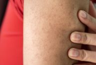 O que é queratose pilar? Conheça causas e tratamento