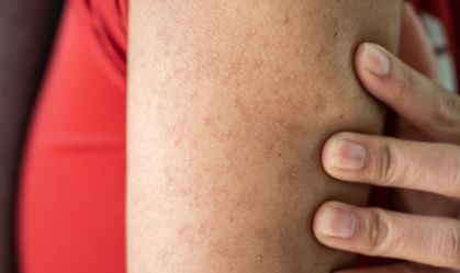 Queratinose pilar é uma condição dermatológica caracterizada pelo aparecimento de manchas vermelhas com erupção de bolinhas brancas formadas por queratina