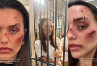 Rafa Kalimann aparece com ferimentos no rosto em bastidores de série; veja