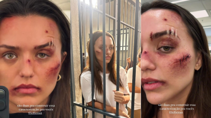 Rafa Kalimann apareceu com pontos cirúrgicos e machucados artificiais e disse que são necessárias duas profissionais para fazer sua caracterização para a personagem Paloma